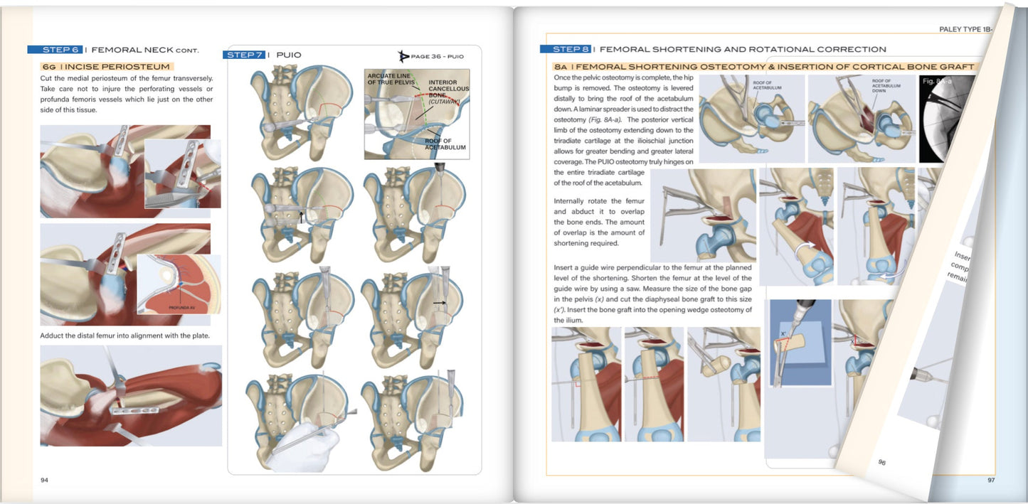 CFD Congenital Femoral Deficiency, First Edition (Event Discount Used)