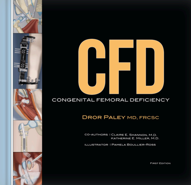 CFD Congenital Femoral Deficiency, First Edition Book