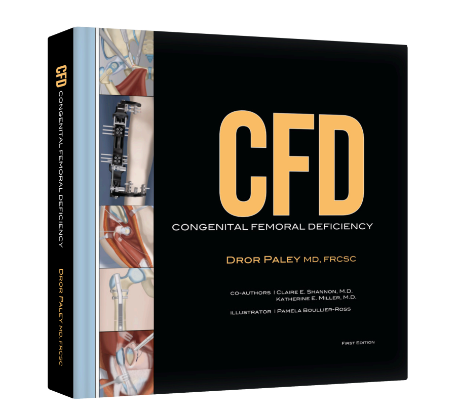 CFD Congenital Femoral Deficiency, First Edition (Event Discount Used)